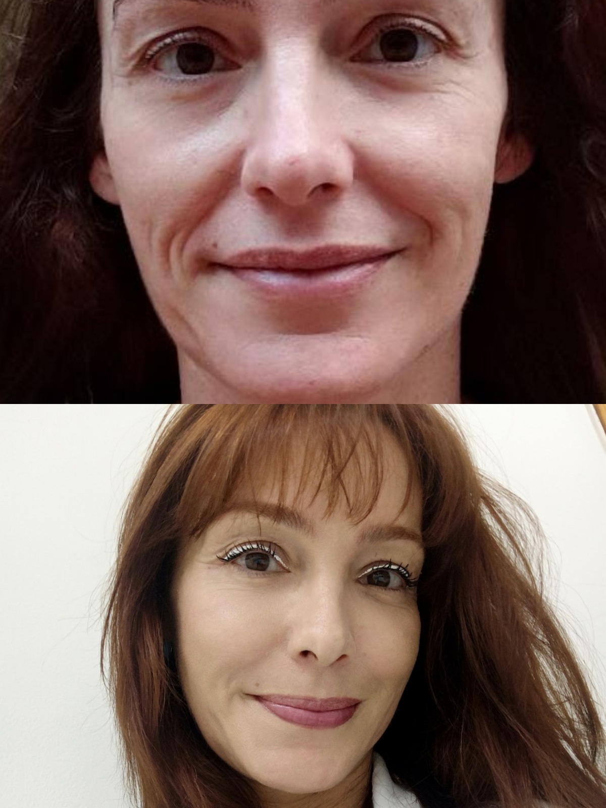 Sculptra - Bioestimulador de Colágeno