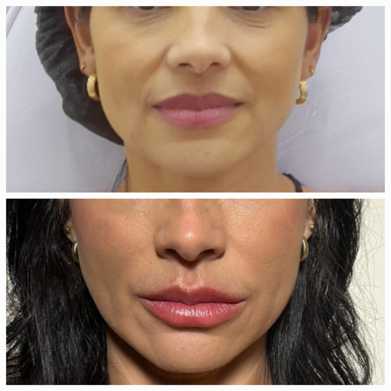 Harmonização Facial